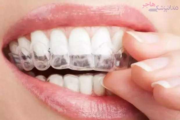 tooth guard